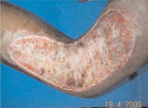 Masivní infekce a začátek nekrózy dlouhé radiační popáleniny na pravé noze 11 týdnů po expozici