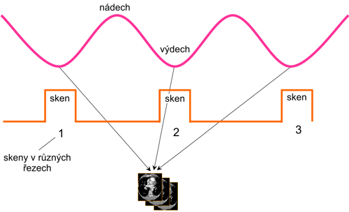 Princip Respiratory Gating plánování