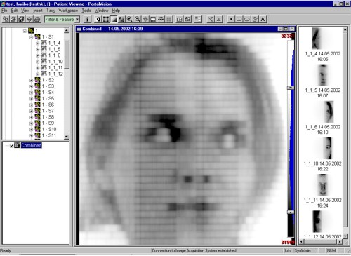 Portrét dívky vyzářený metodou IMRT, zaznamenaný prostřednictvím PortalVision