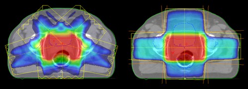 Srovnání IMRT (vlevo) a CRT (vpravo) ozařovacích plánů radioterapie prostaty