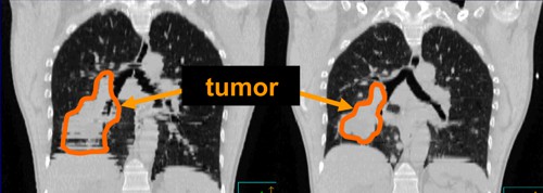 Změna polohy, tvaru a velikosti tumoru plic během dýchání pacienta