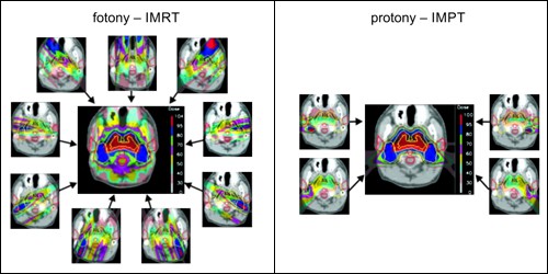 Výhody hadronové IMPT terapie v porovnání s fotonovou IMRT terapií