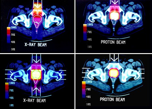 Karcinom prostaty. Srovnání konvenčního záření X (nalevo) a protonových svazků (napravo)