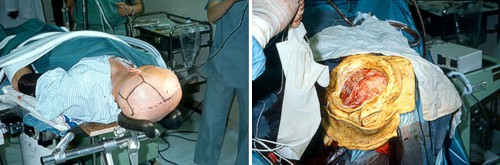 Obnažení mozku pacienta před bór-neutronovou záchytovou terapií